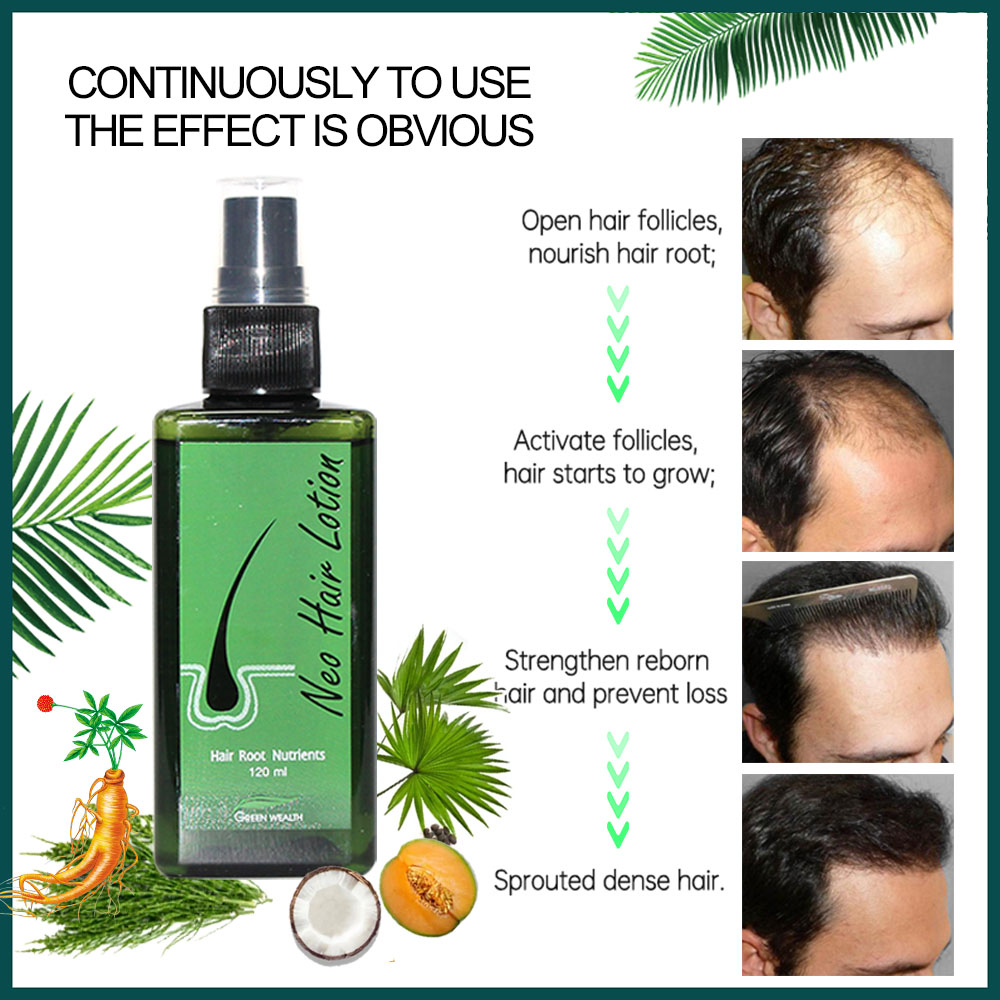 4 pcs Neo Hair Lotion 120ml Ha - Nutrition And Fitness recension och pris
